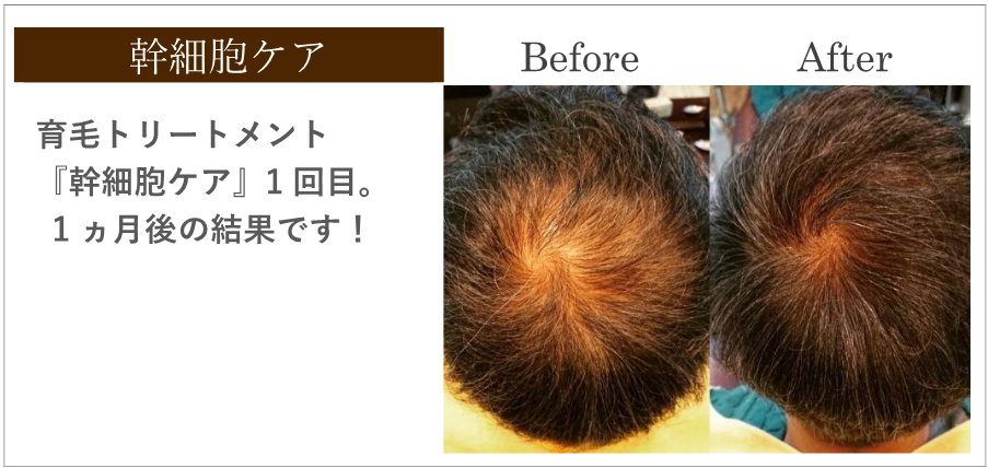 福岡の育毛「幹細胞ケア」